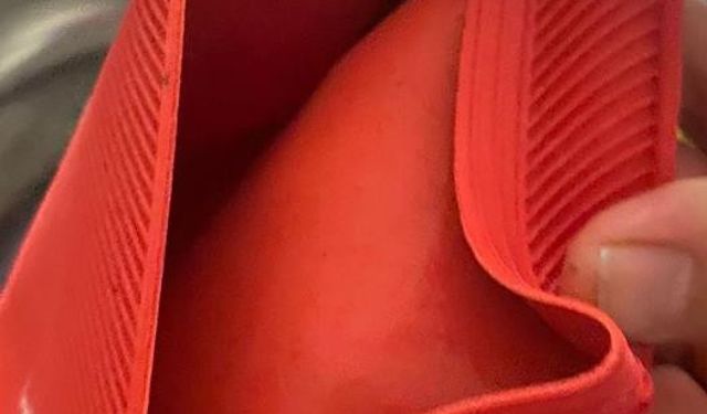 Sıcak su torbası patladı, vücudunun yüzde 25'i yandı