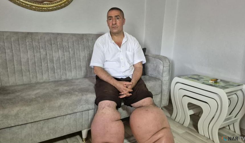 15 yıldır fil hastalığıyla mücadele ediyor.