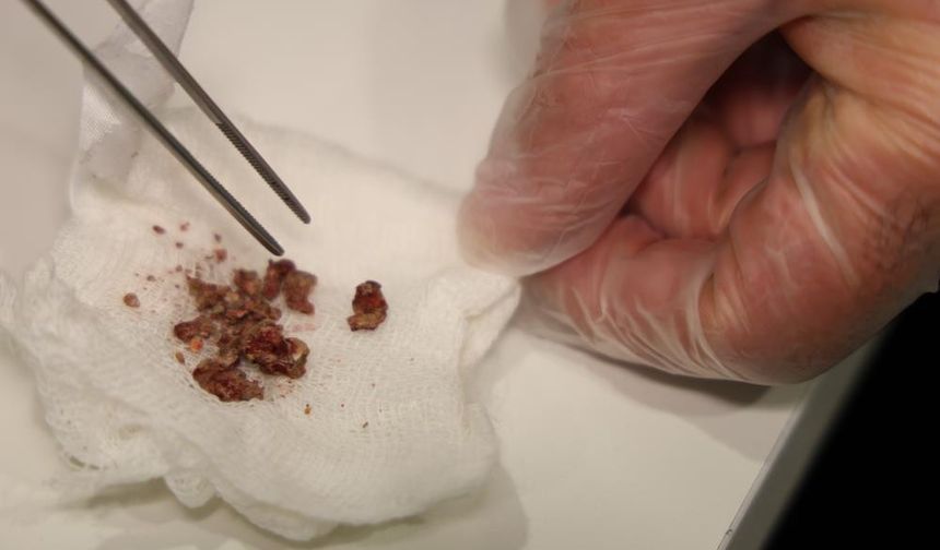 Estetik ameliyatta şaşırtan olay, burundan taş çıktı.